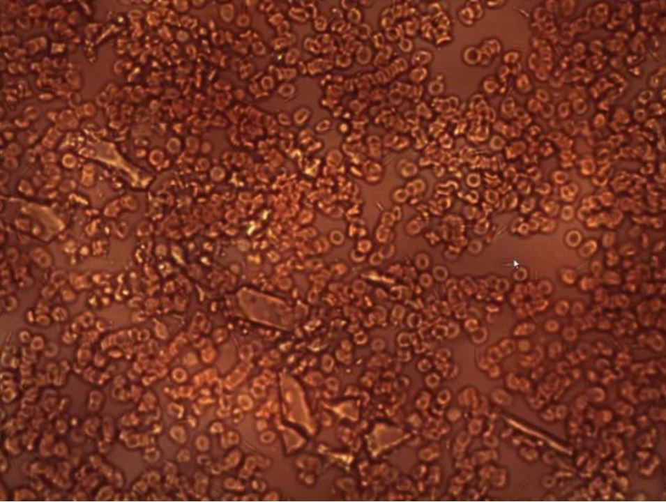 Sangre de niño sin vacunar contagiado de los padres vacunados.JPG