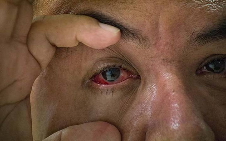 La conjuntivitis es uno de los síntomas del virus de Marburgo.jpg