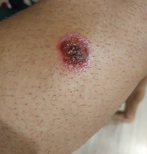 heridas en la piel 1.PNG